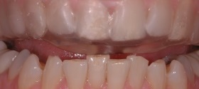 Bruxism_002