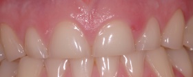 Bruxism_Severe_Tooth_Erosion_a