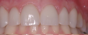 Bruxism_Severe_Tooth_Erosion_b