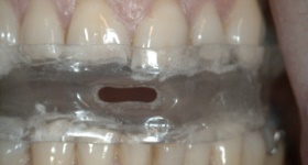 Oral_Appliance_01