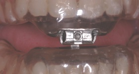 Oral_Appliance_02