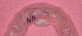 Bruxism_001