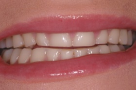 Bruxism_Reduced_Tooth_Visibilty
