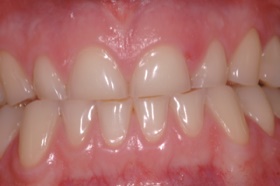 Bruxism_Severe_Wear