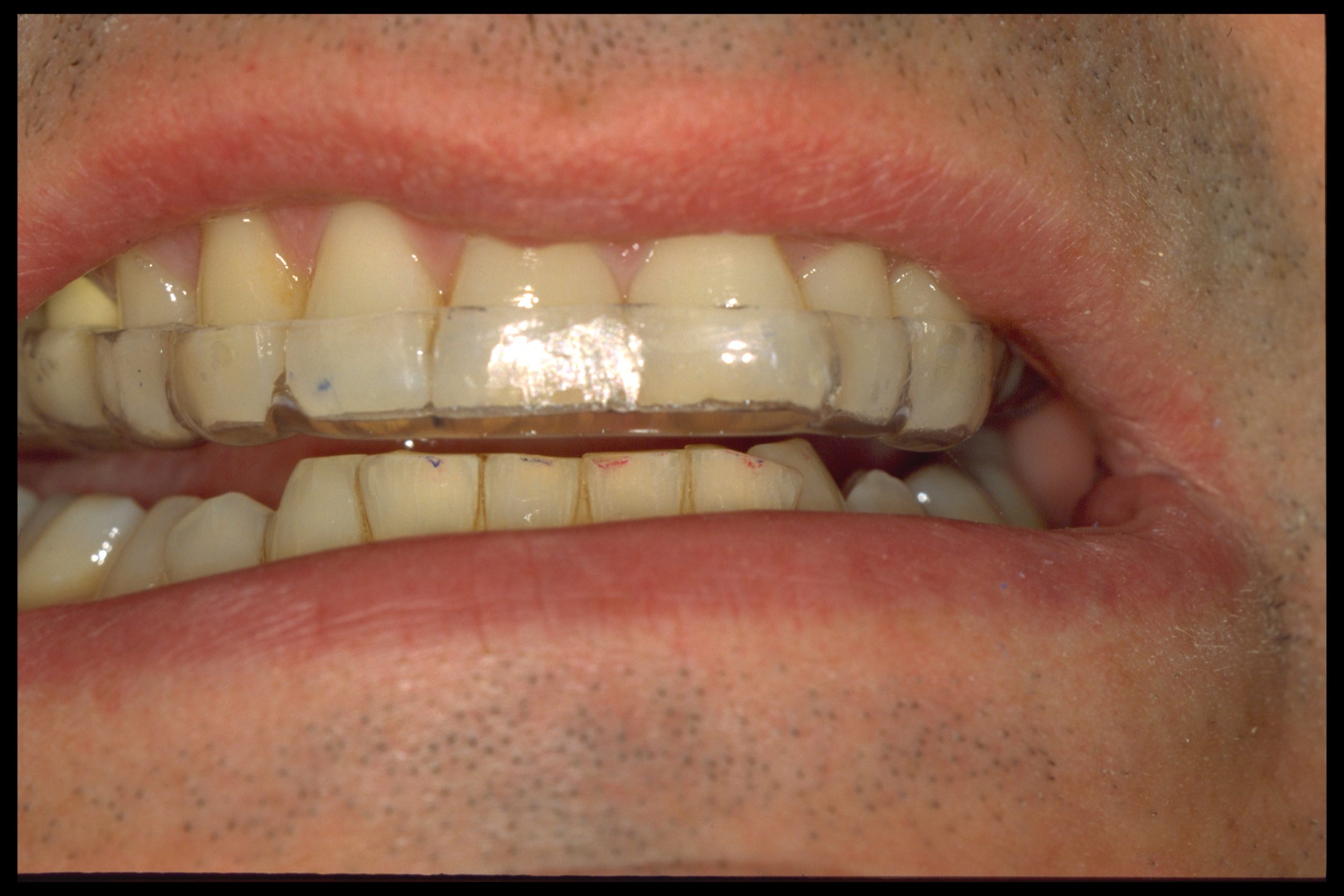 Bite Guard In place