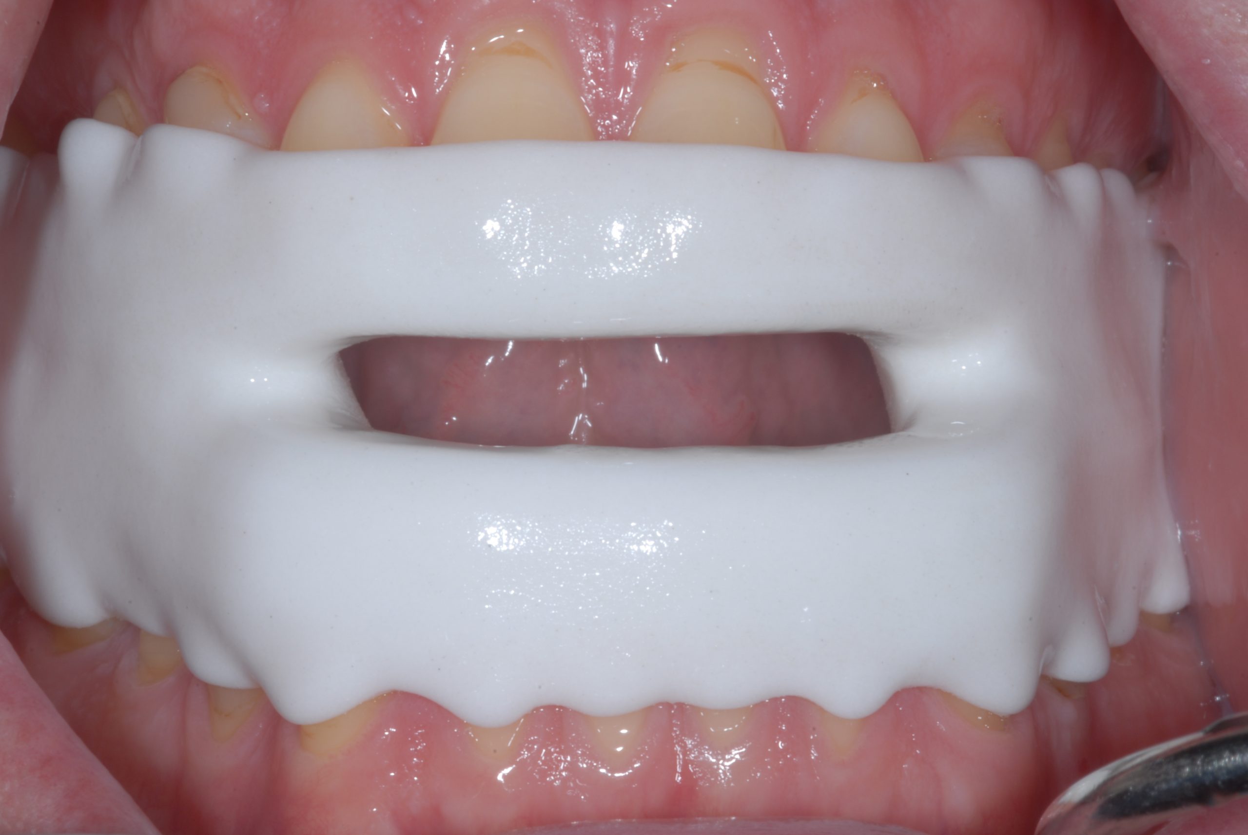 Printed Sleep Apnoea Device