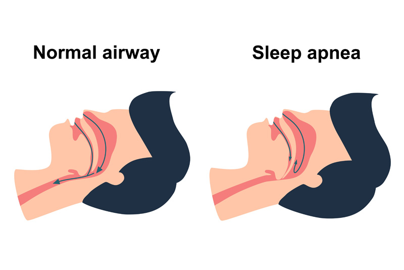Snoring Problems Referrals Dublin
